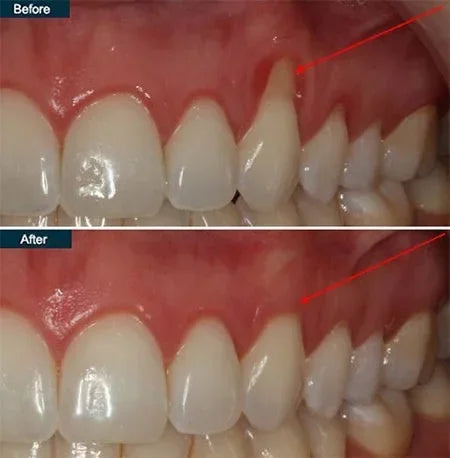 Gum Protect Gel！