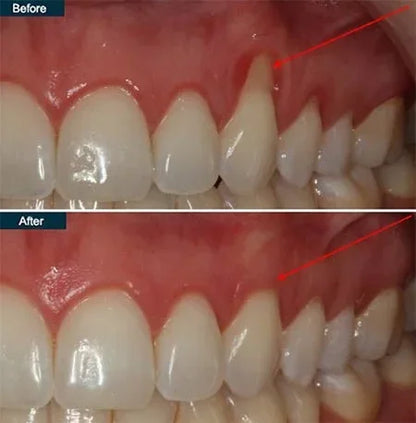 Gum Protect Gel！